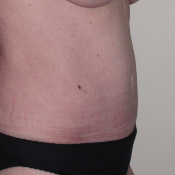 Side view of patient after Adbominoplasty Surgery